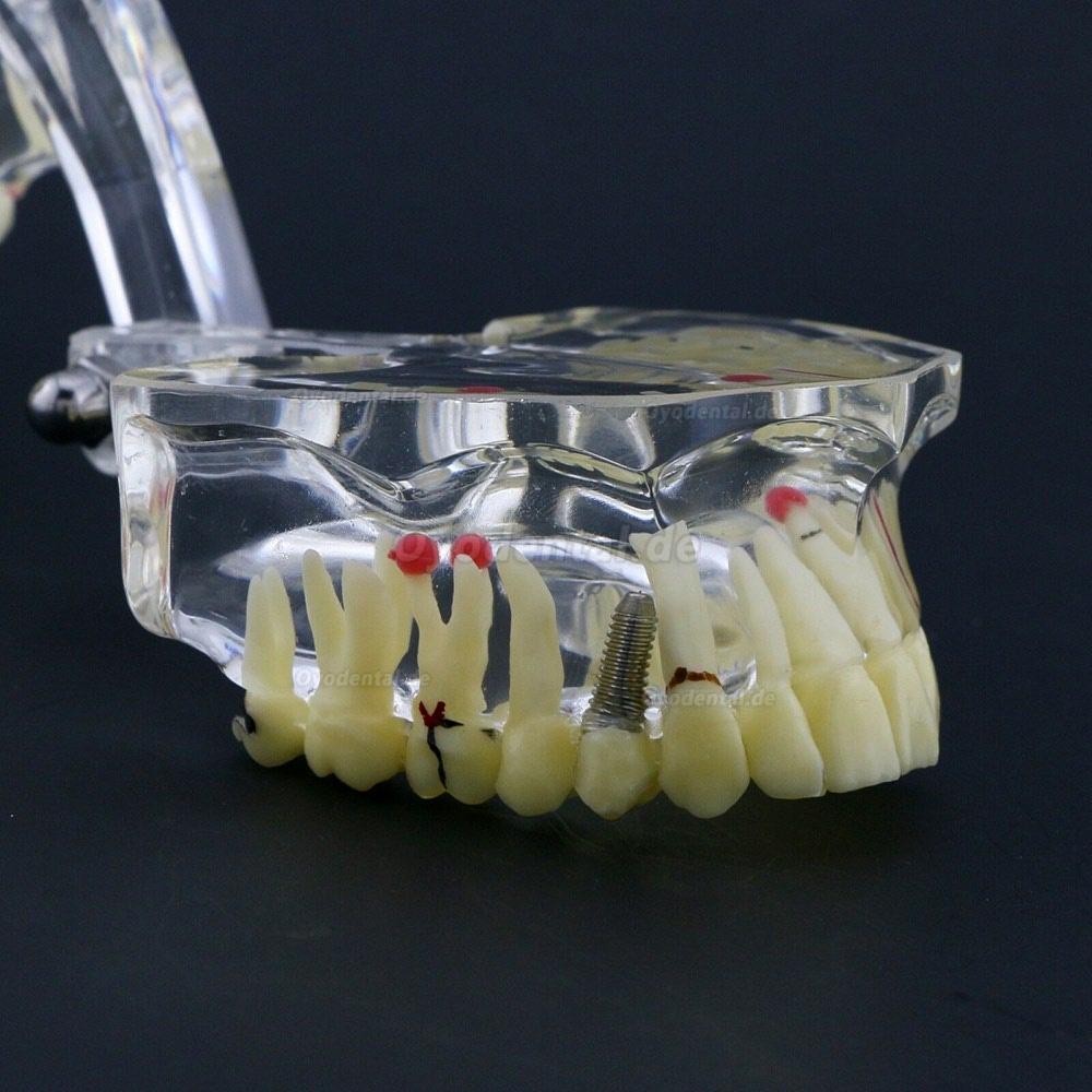 Neue Dental Teach-Studie Allgemeine Erwachsenenpathologie Typodont Zähne Modell # 4001
