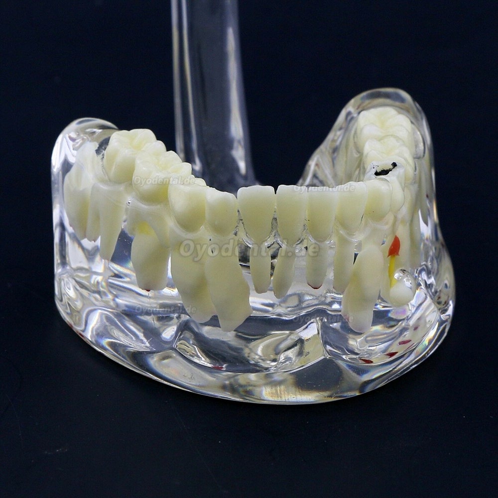 Neue Zahnheilkunde Kinder Pädiatrische Pathologie Demonstrationsstudie Zähne Modell 4002