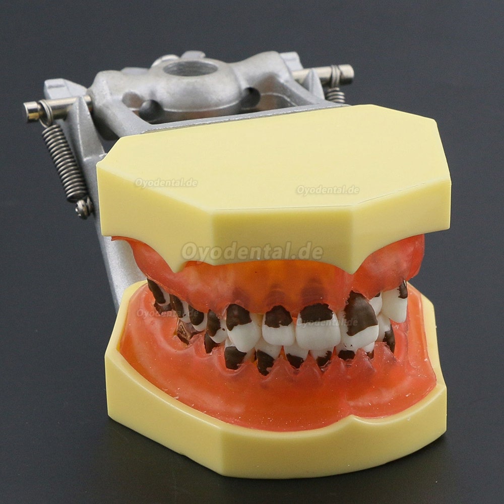 Das Modell der Parodontose zeigt entzündete Zahnfleischkalküle 4003