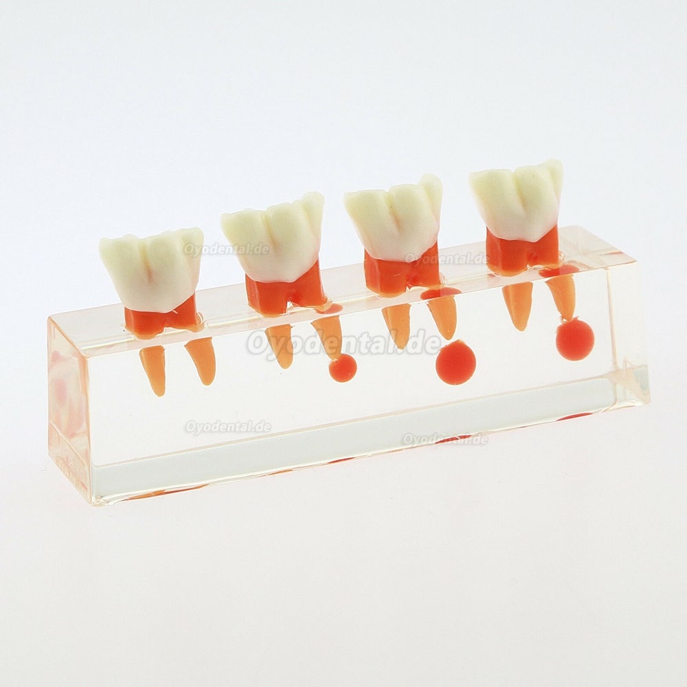 Zahnzähne Modell 4-stufige endodontische Behandlungsstudie Unterrichten Sie Modell 4018 01