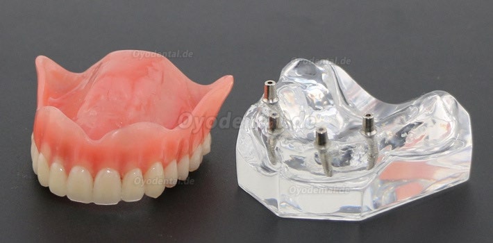 Anatomisches Modell der Zahnzähne Überprothese Superior mit 4 Implantaten Demo Modell 6001