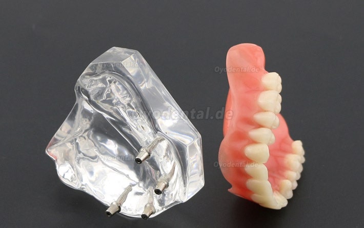 Anatomisches Modell der Zahnzähne Überprothese Superior mit 4 Implantaten Demo Modell 6001 Anatomisches Modell der Zahnzähne Überprothese Superior mit 4 Implantaten Demo Modell 6001