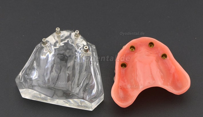 Anatomisches Modell der Zahnzähne Überprothese Superior mit 4 Implantaten Demo Modell 6001 Anatomisches Modell der Zahnzähne Überprothese Superior mit 4 Implantaten Demo Modell 6001