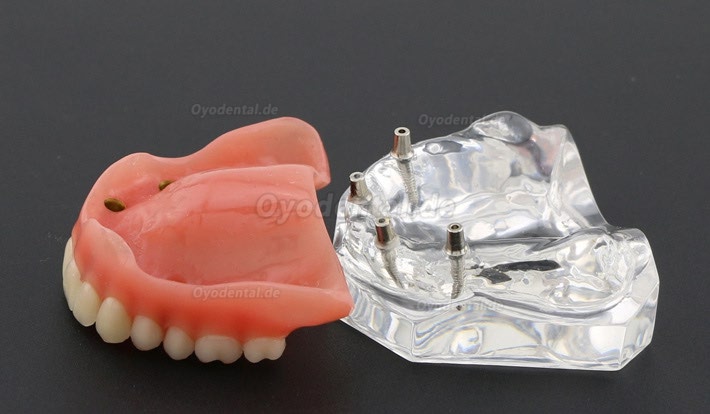 Anatomisches Modell der Zahnzähne Überprothese Superior mit 4 Implantaten Demo Modell 6001