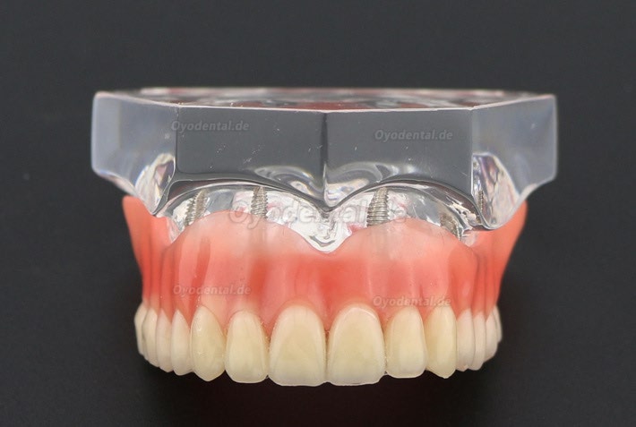 Anatomisches Modell der Zahnzähne Überprothese Superior mit 4 Implantaten Demo Modell 6001 Anatomisches Modell der Zahnzähne Überprothese Superior mit 4 Implantaten Demo Modell 6001