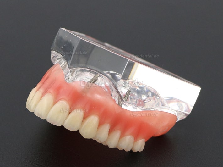 Anatomisches Modell der Zahnzähne Überprothese Superior mit 4 Implantaten Demo Modell 6001 Anatomisches Modell der Zahnzähne Überprothese Superior mit 4 Implantaten Demo Modell 6001