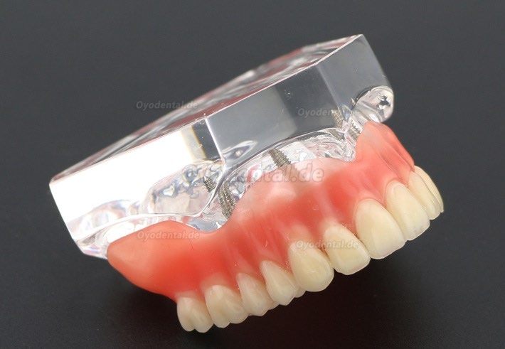 Anatomisches Modell der Zahnzähne Überprothese Superior mit 4 Implantaten Demo Modell 6001 Anatomisches Modell der Zahnzähne Überprothese Superior mit 4 Implantaten Demo Modell 6001