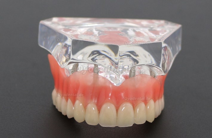 Anatomisches Modell der Zahnzähne Überprothese Superior mit 4 Implantaten Demo Modell 6001 Anatomisches Modell der Zahnzähne Überprothese Superior mit 4 Implantaten Demo Modell 6001