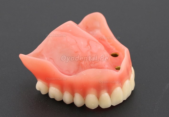 Anatomisches Modell der Zahnzähne Überprothese Superior mit 4 Implantaten Demo Modell 6001 Anatomisches Modell der Zahnzähne Überprothese Superior mit 4 Implantaten Demo Modell 6001