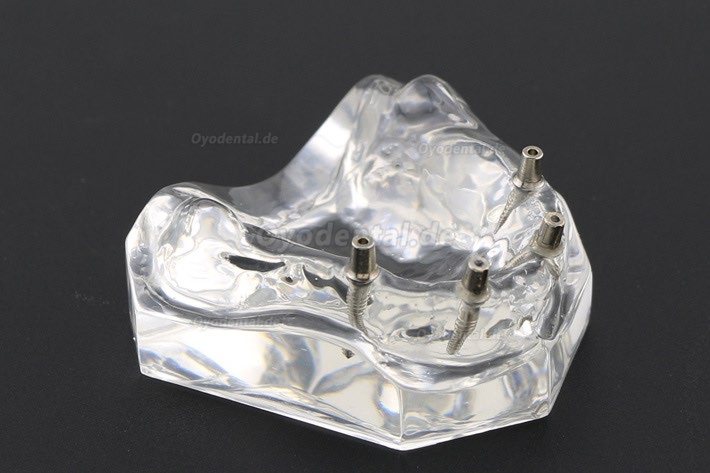 Anatomisches Modell der Zahnzähne Überprothese Superior mit 4 Implantaten Demo Modell 6001 Anatomisches Modell der Zahnzähne Überprothese Superior mit 4 Implantaten Demo Modell 6001