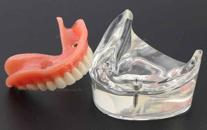 Modell für zahnärztliche Oberzähne Overdenture Superior 4 Implantate Demo Modell 6001 02