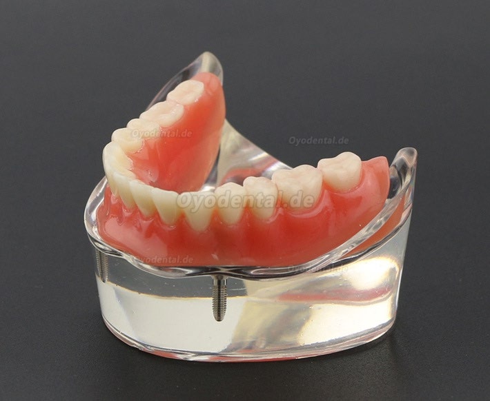 Modell für zahnärztliche Oberzähne Overdenture Superior 4 Implantate Demo Modell 6001 02