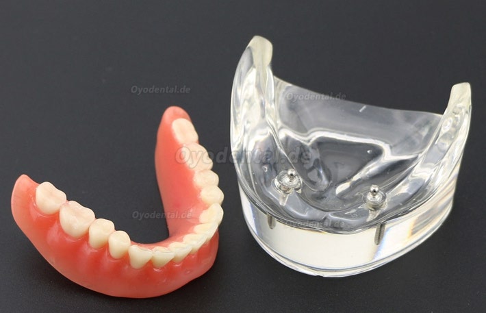 Modell für zahnärztliche Oberzähne Overdenture Superior 4 Implantate Demo Modell 6001 02