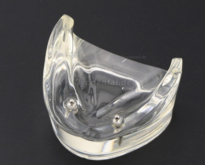 Modell für zahnärztliche Oberzähne Overdenture Superior 4 Implantate Demo Modell 6001 02