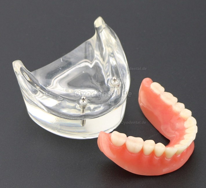 Modell für zahnärztliche Oberzähne Overdenture Superior 4 Implantate Demo Modell 6001 02