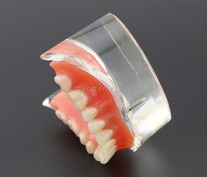 Modell für zahnärztliche Oberzähne Overdenture Superior 4 Implantate Demo Modell 6001 02