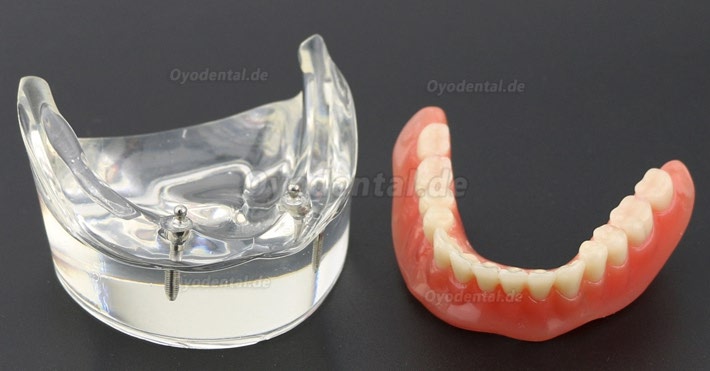 Modell für Zahnzähne Überprothese minderwertig bei 2 Implantaten Demo-Modell 6002 01