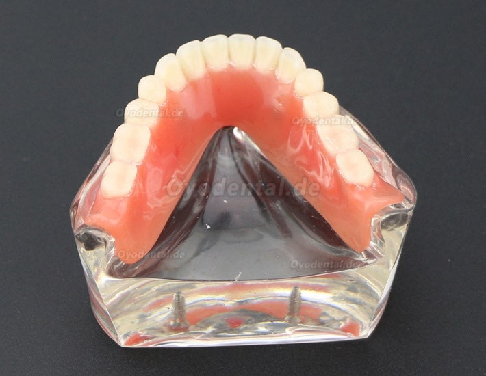 Modell für Zahnzähne Überprothese minderwertig bei 2 Implantaten Demo-Modell 6002 01