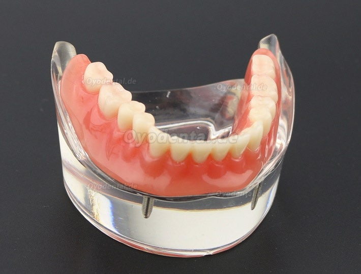 Modell für Zahnzähne Überprothese minderwertig bei 2 Implantaten Demo-Modell 6002 01