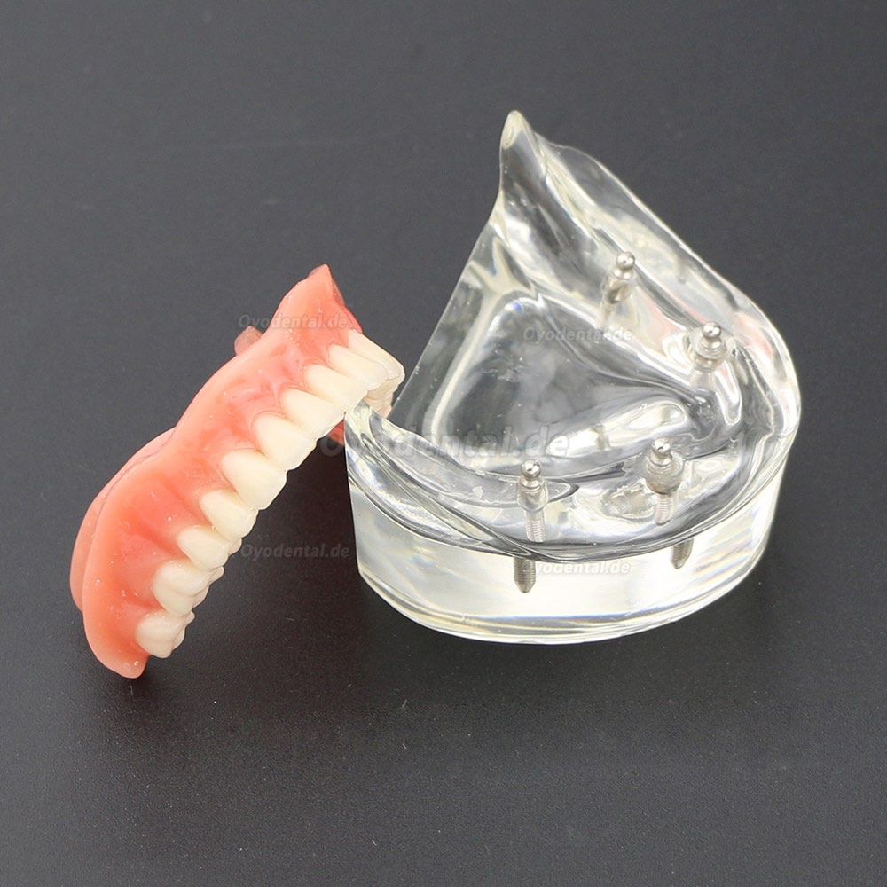 Dental Lower Zähne Demo-Studienmodell 6002 02 Overdenture Unten 4 Implantate