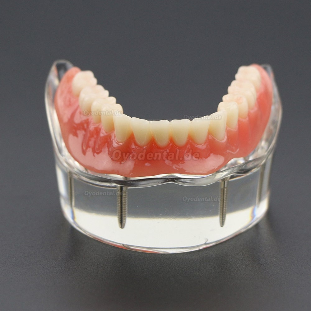 Dental Lower Zähne Demo-Studienmodell 6002 02 Overdenture Unten 4 Implantate