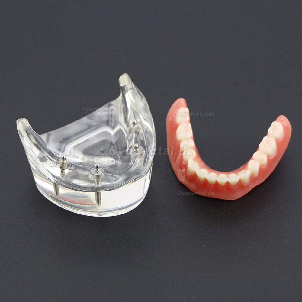 Dental Lower Zähne Demo-Studienmodell 6002 02 Overdenture Unten 4 Implantate