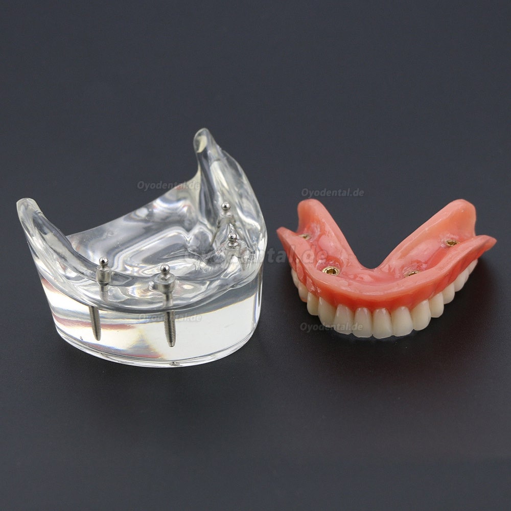 Dental Lower Zähne Demo-Studienmodell 6002 02 Overdenture Unten 4 Implantate