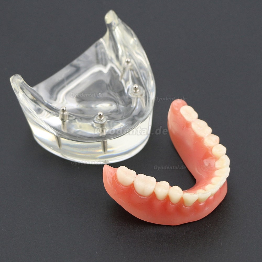 Dental Lower Zähne Demo-Studienmodell 6002 02 Overdenture Unten 4 Implantate