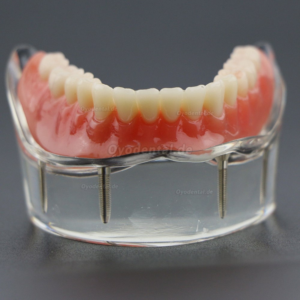 Dental Lower Zähne Demo-Studienmodell 6002 02 Overdenture Unten 4 Implantate