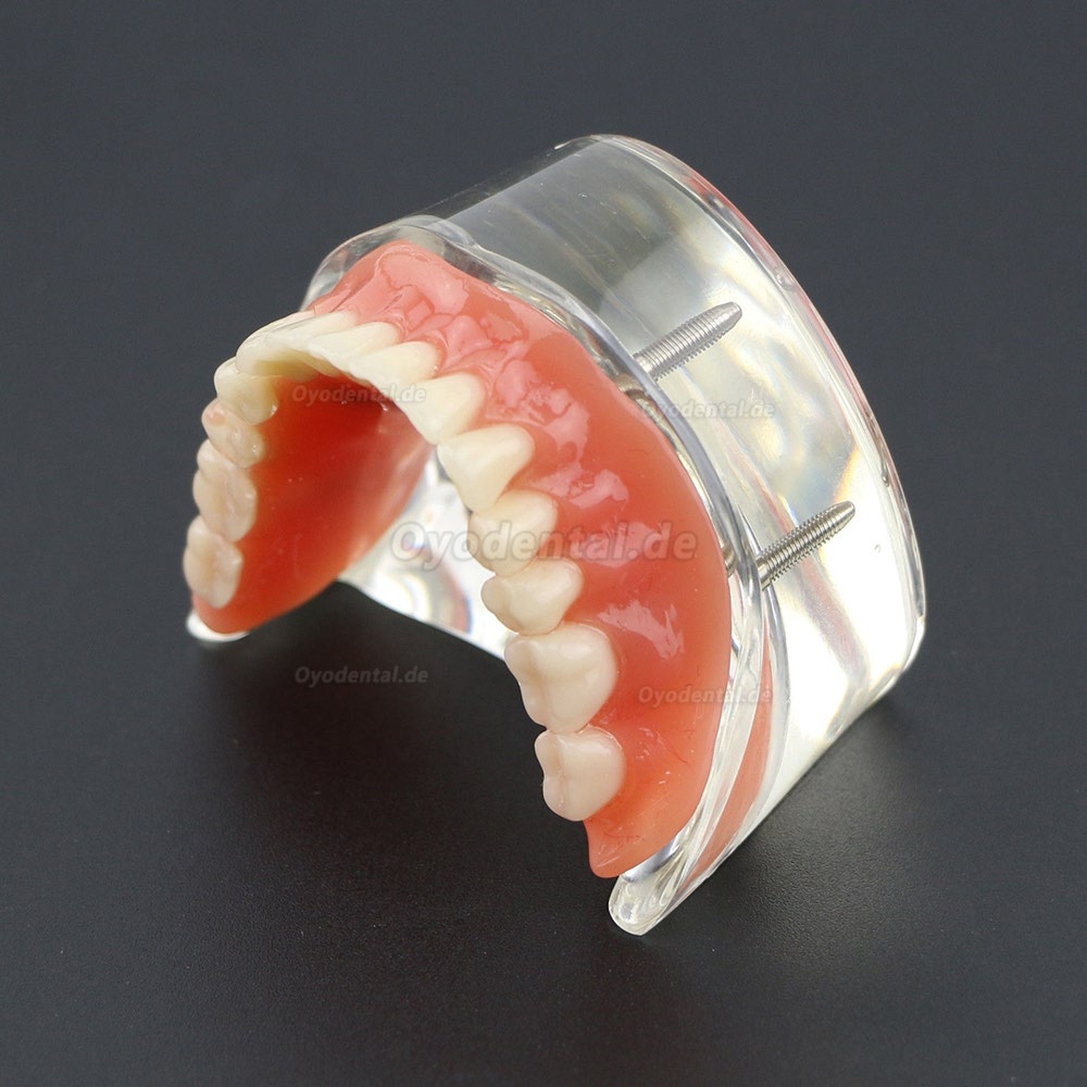 Dental Lower Zähne Demo-Studienmodell 6002 02 Overdenture Unten 4 Implantate