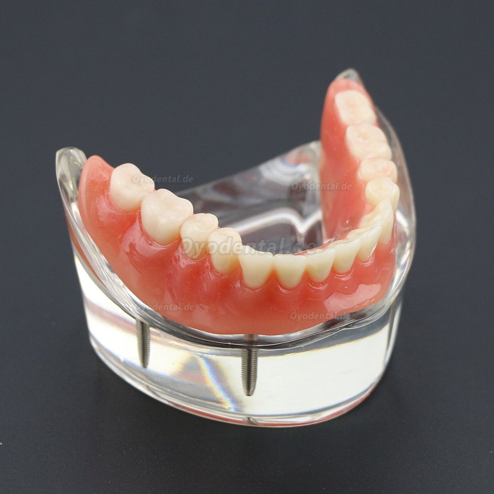 Dental Lower Zähne Demo-Studienmodell 6002 02 Overdenture Unten 4 Implantate