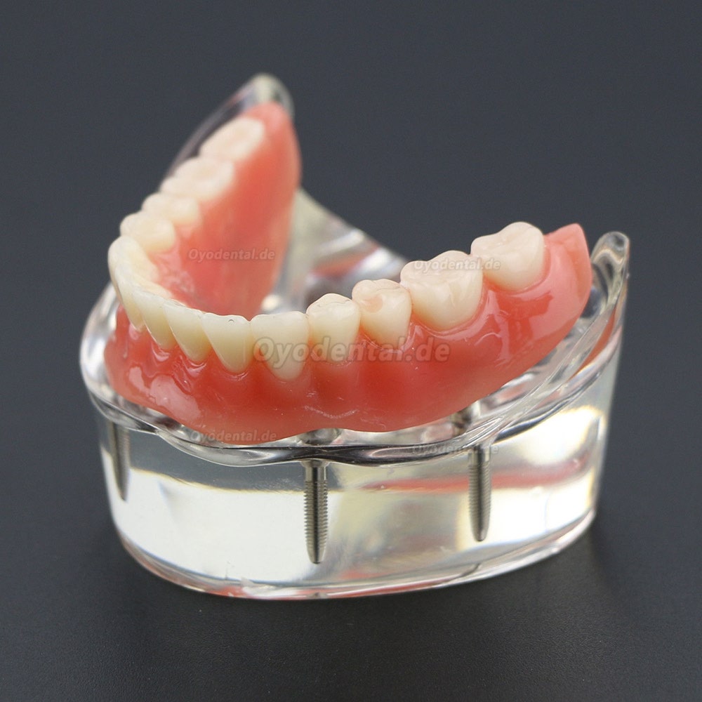 Dental Lower Zähne Demo-Studienmodell 6002 02 Overdenture Unten 4 Implantate