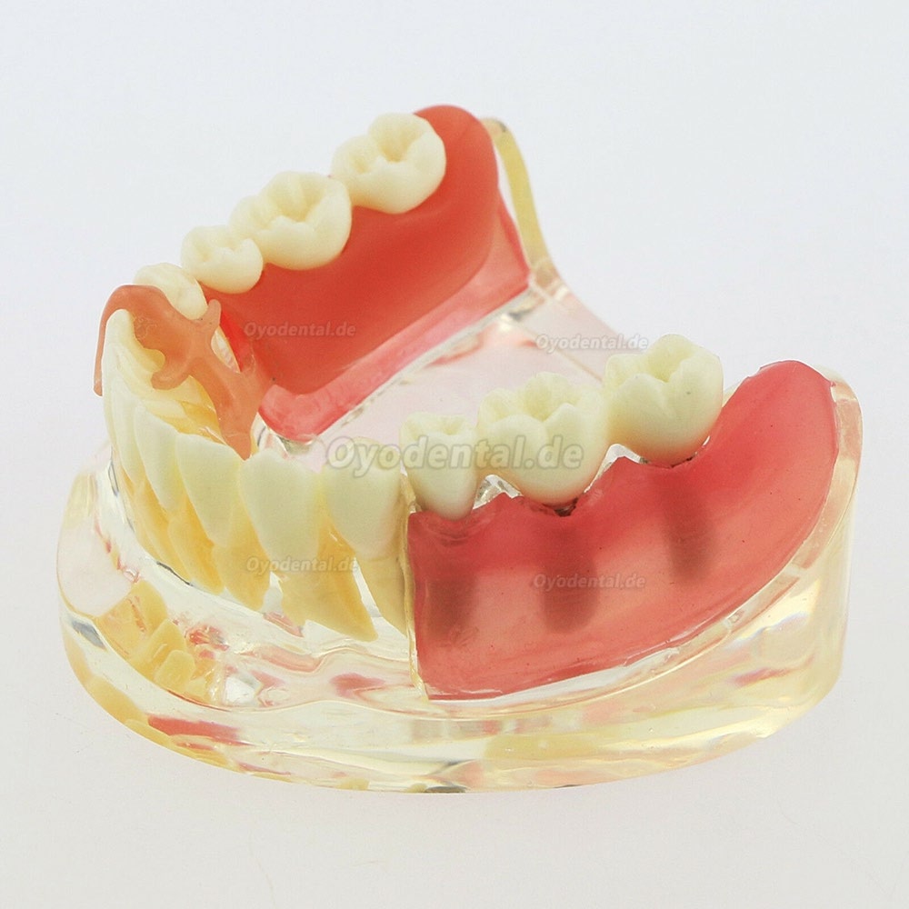 Dental Zähne Modell minderwertig abnehmbare Restauration Implantatbrücke Demo Modell 6006