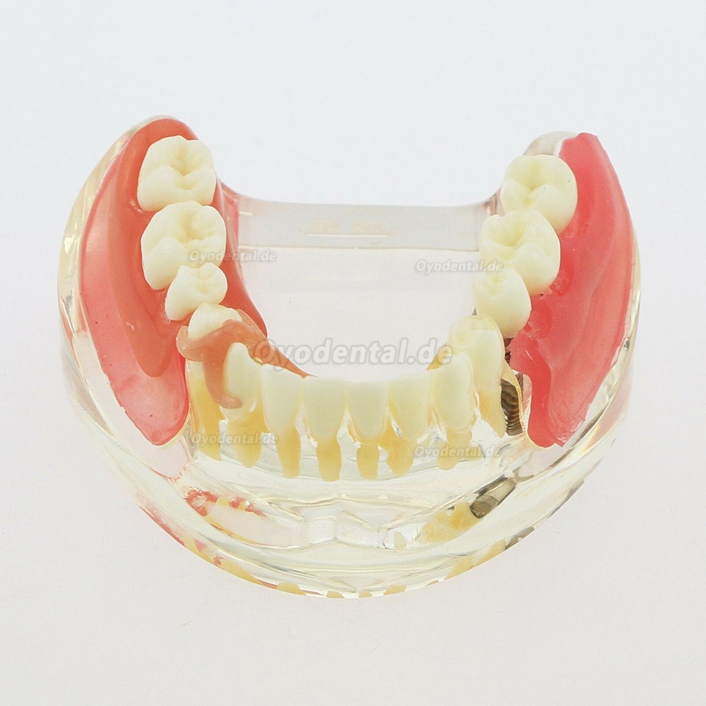 Dental Zähne Modell minderwertig abnehmbare Restauration Implantatbrücke Demo Modell 6006