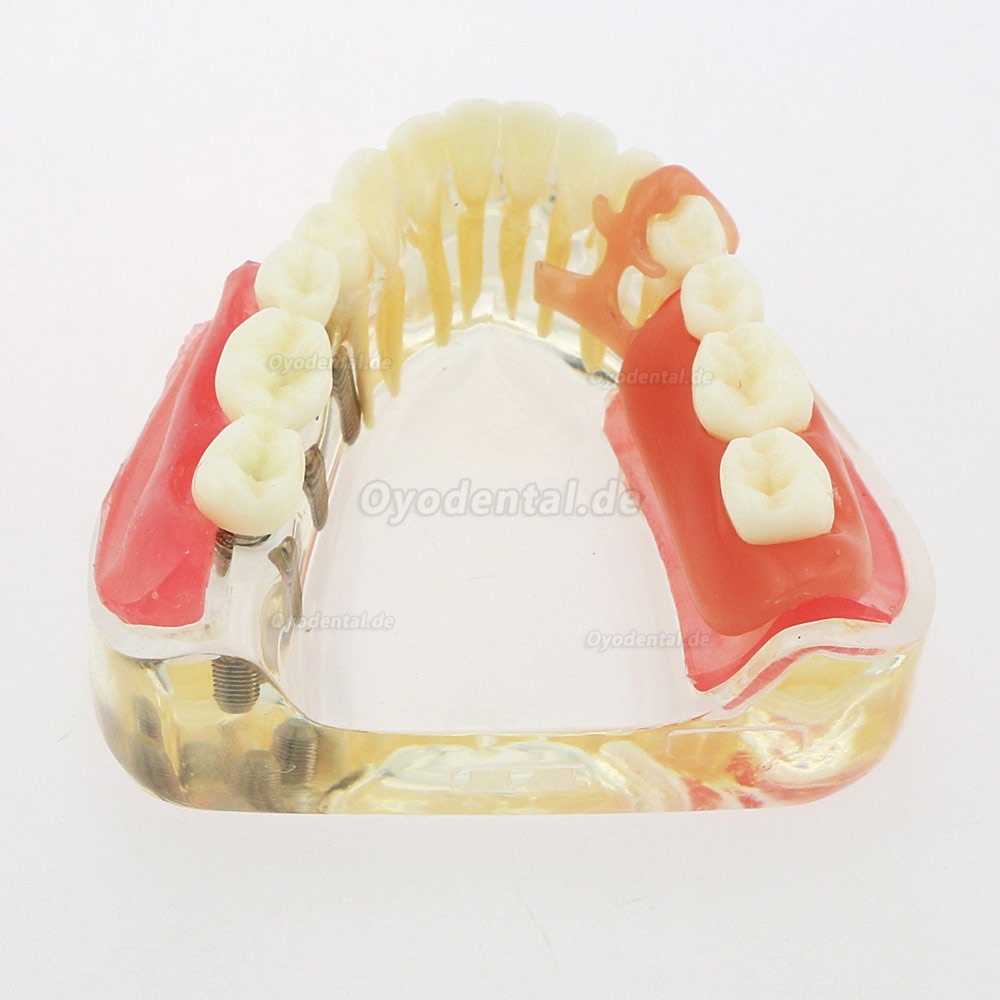 Dental Zähne Modell minderwertig abnehmbare Restauration Implantatbrücke Demo Modell 6006