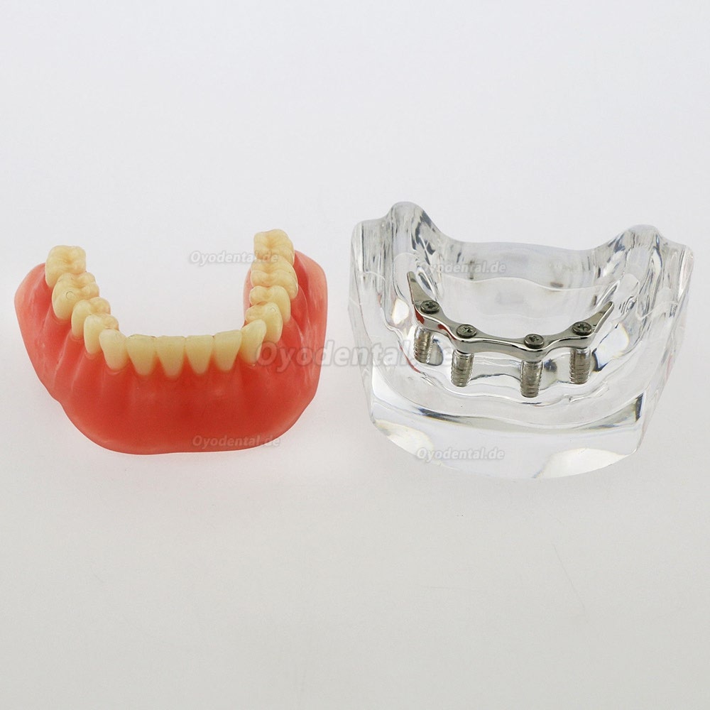 Dental Minderwertige Zähne Modell Overdenture Precision 4 Implantate Demo Silver Bar