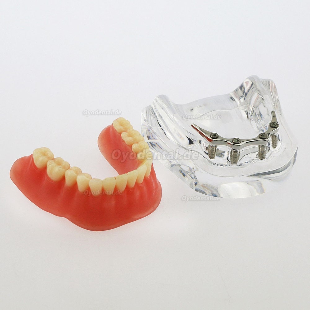 Dental Minderwertige Zähne Modell Overdenture Precision 4 Implantate Demo Silver Bar