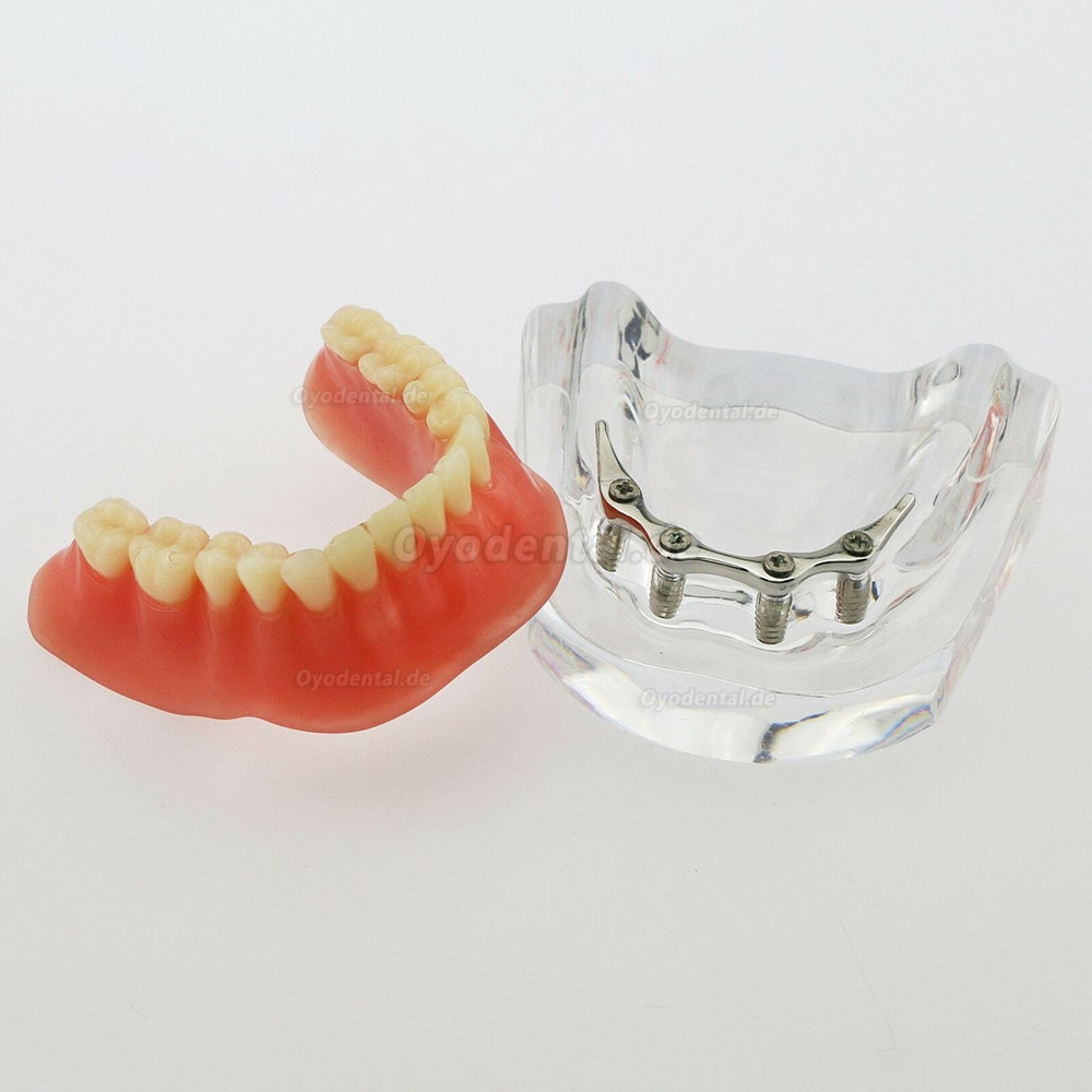 Dental Minderwertige Zähne Modell Overdenture Precision 4 Implantate Demo Silver Bar