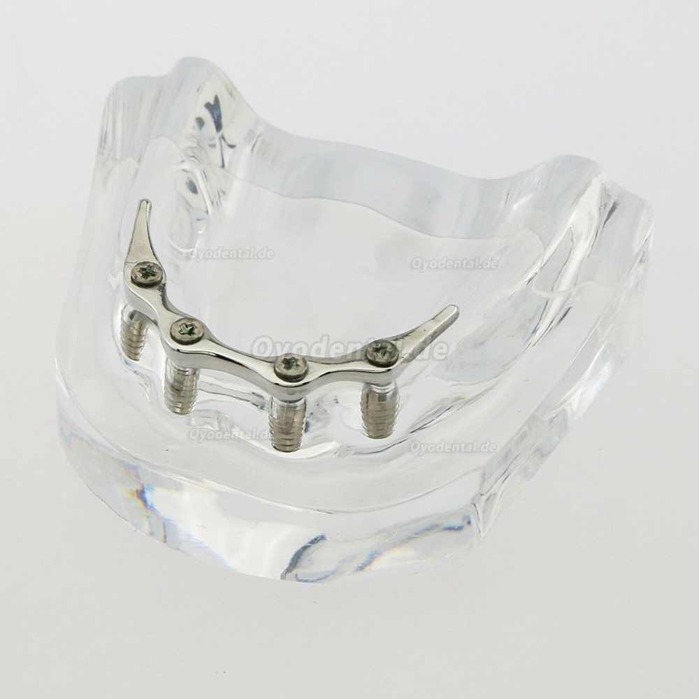 Dental Minderwertige Zähne Modell Overdenture Precision 4 Implantate Demo Silver Bar