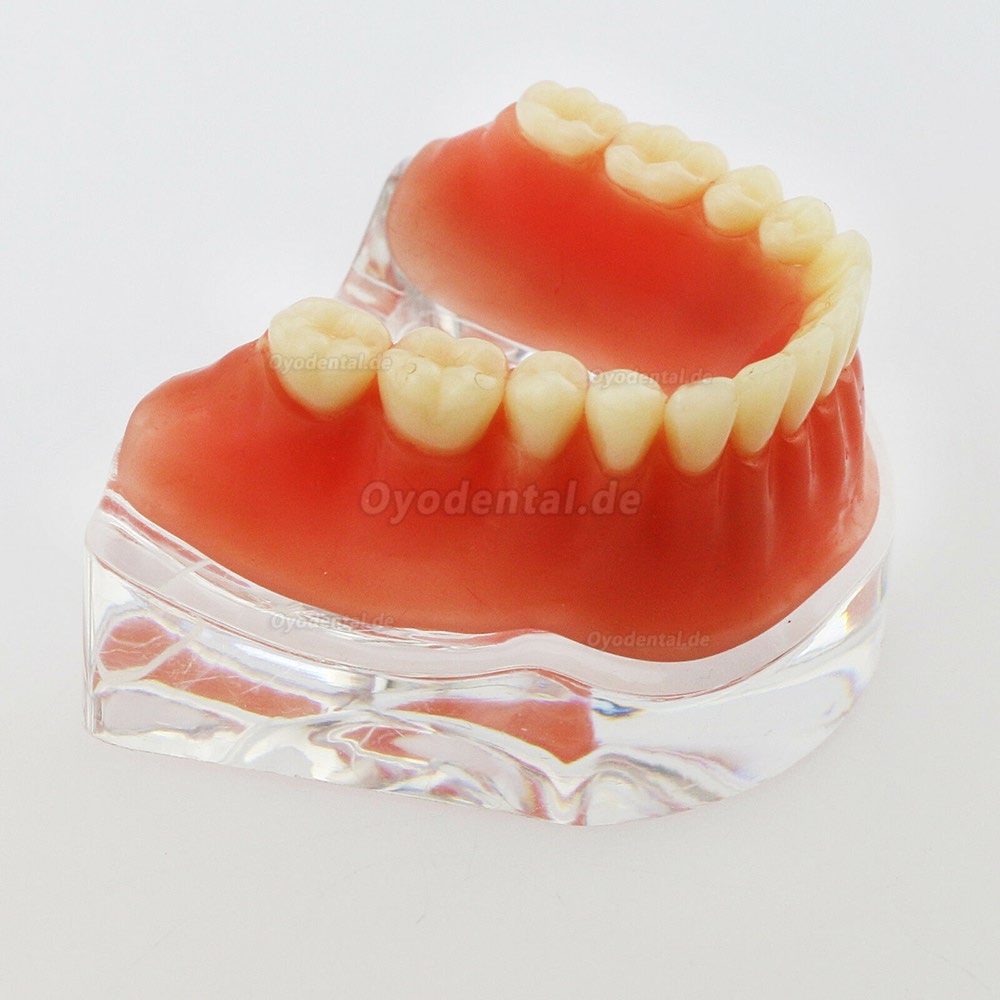 Dental Minderwertige Zähne Modell Overdenture Precision 4 Implantate Demo Silver Bar