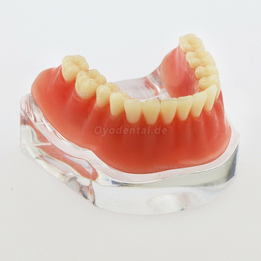 Dental Minderwertige Zähne Modell Overdenture Precision 4 Implantate Demo Silver Bar