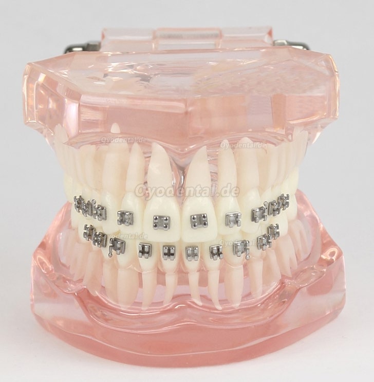 Dental Kieferorthopädie Behandlung Modell Demo Zähne MetallbracketsModel M3001