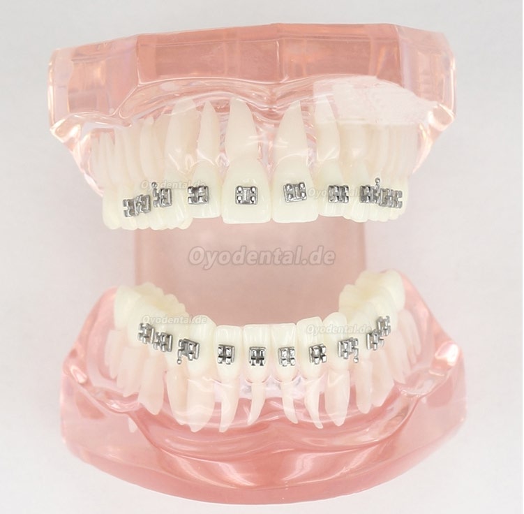 Dental Kieferorthopädie Behandlung Modell Demo Zähne MetallbracketsModel M3001