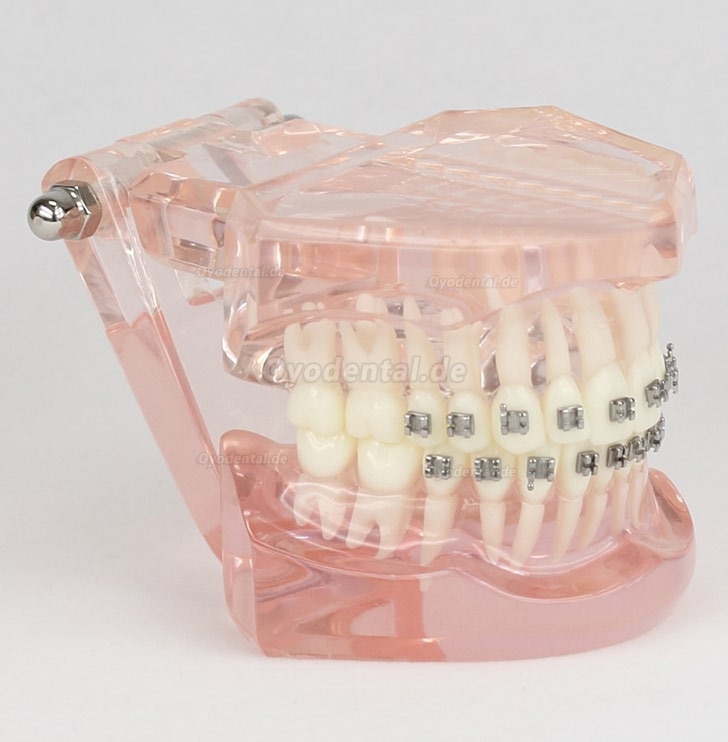 Dental Kieferorthopädie Behandlung Modell Demo Zähne MetallbracketsModel M3001