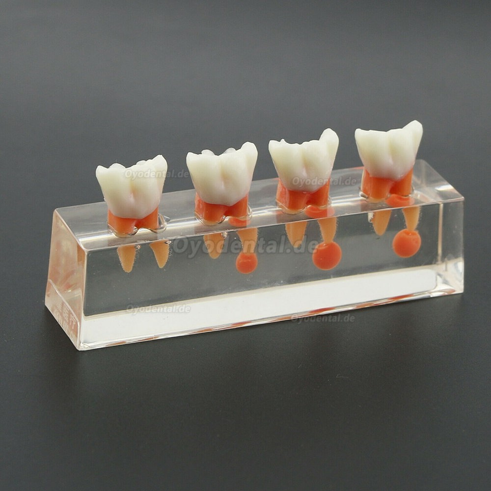 Zahnzahnmodell 4-stufige endodontische Behandlung zeigt anatomisches M4018-01