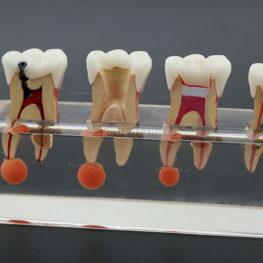 Zahnzahnmodell 4-stufige endodontische Behandlung zeigt anatomisches M4018-01