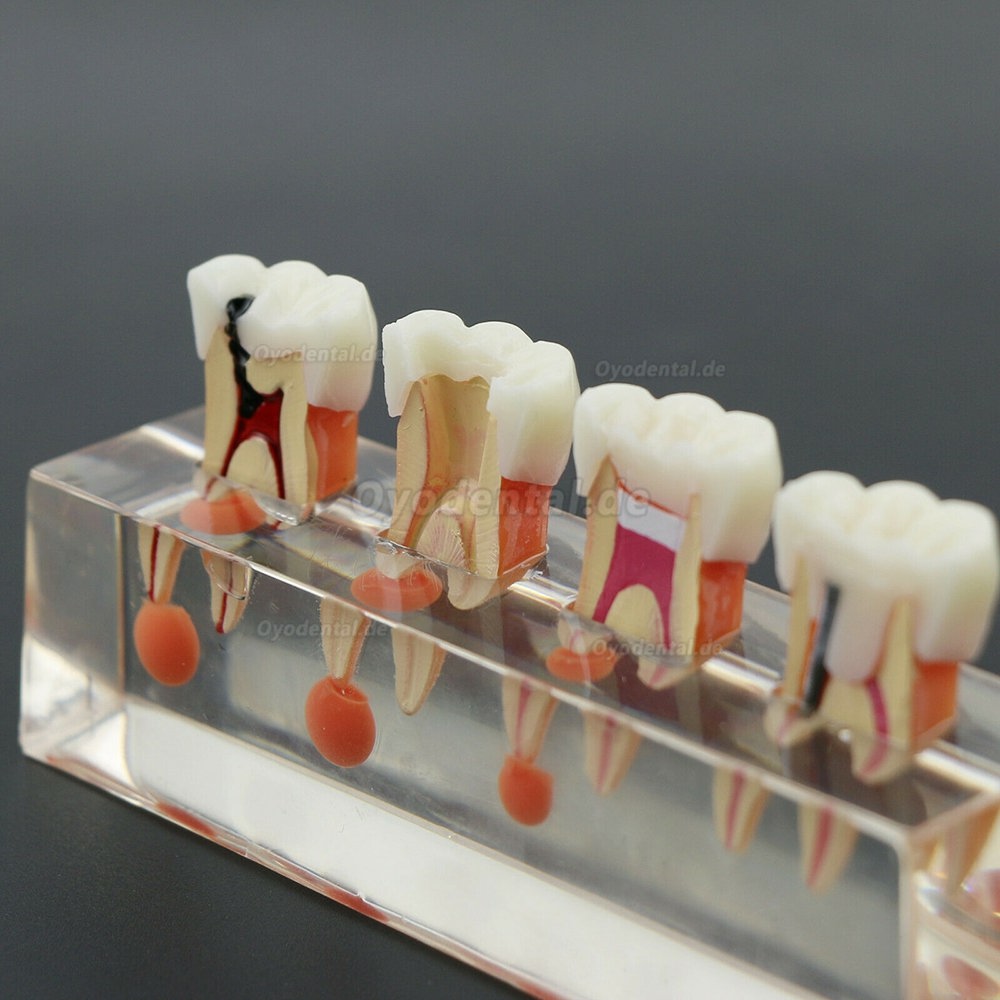 Zahnzahnmodell 4-stufige endodontische Behandlung zeigt anatomisches M4018-01