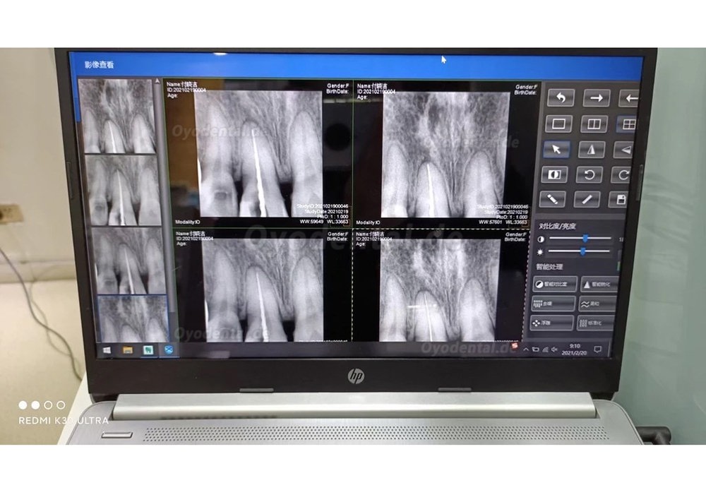 Dental RVG Digitaler Röntgensensor Intraoraler Röntgensensor Intraoralsensoren