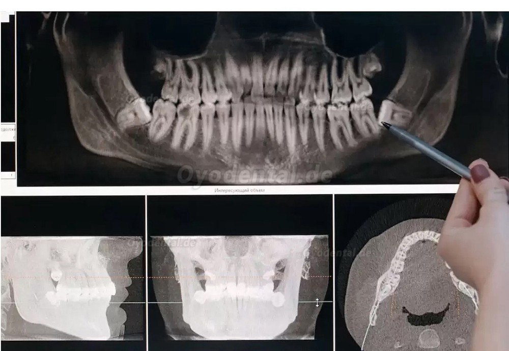 Refine MaxSurgery Geräte für Piezochirurgie Zahnarzt Ultraschall-Piezo-Knochenchirurgiesystem