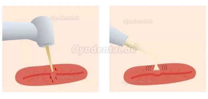 Refine MaxSurgery Geräte für Piezochirurgie Zahnarzt Ultraschall-Piezo-Knochenchirurgiesystem